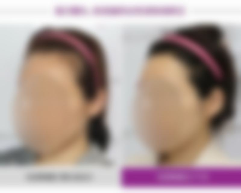 割完双眼皮后多久能化妆,这和修复正常有什么关系
