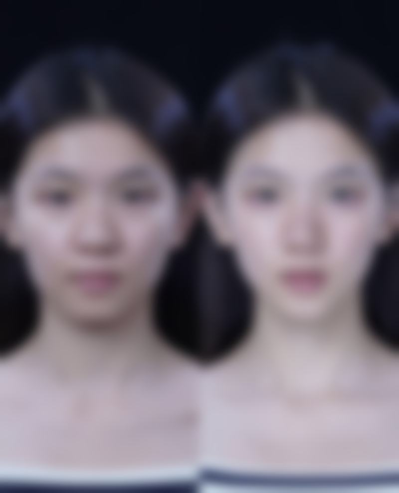 割完双眼皮修复正常的时间受手术方式影响大吗