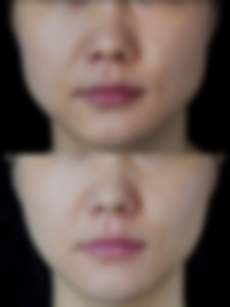 如何确定自体脂肪移植隆胸一次的合适注射量