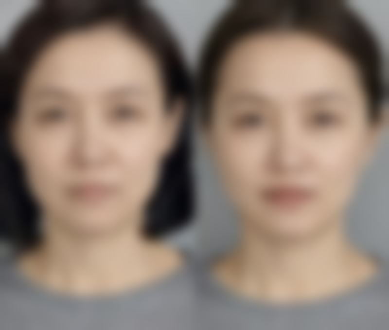 超声 刀改善眼袋适合吗