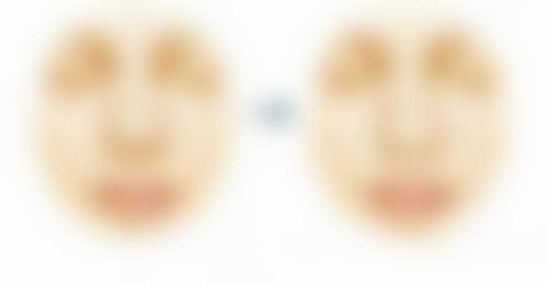 做眼袋手术全麻靠谱吗