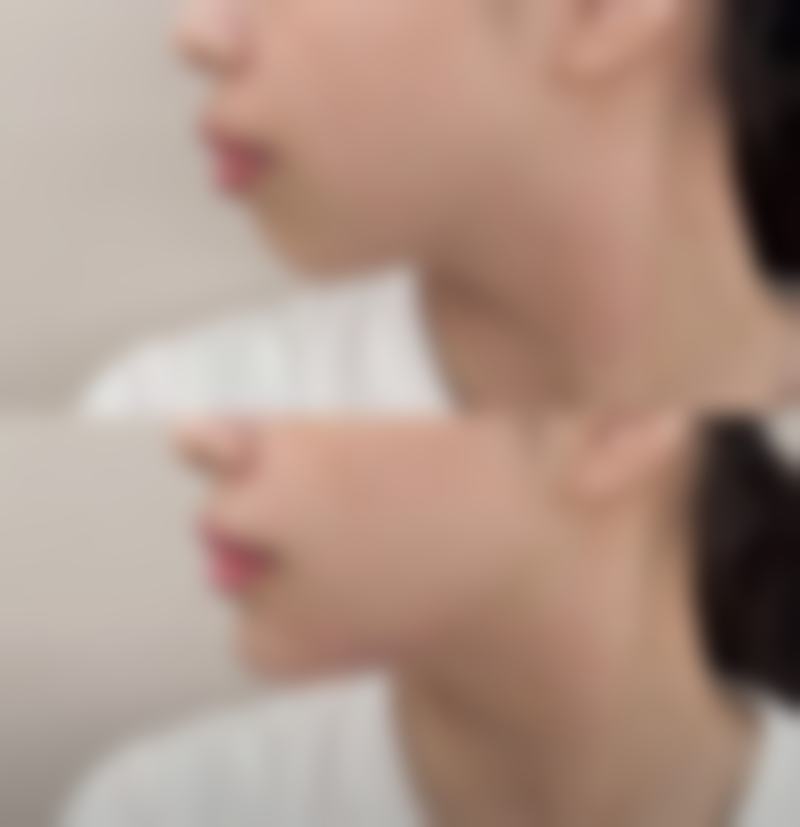 做眼袋手术全麻有什么好处