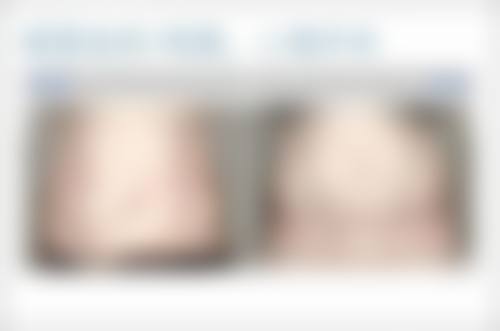 怎样判断去除眼袋淤青的方法是否有效