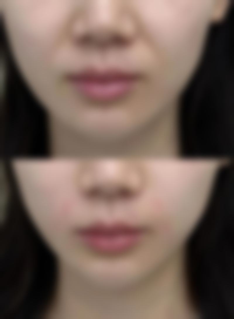 假体隆胸对生育功能有什么影响