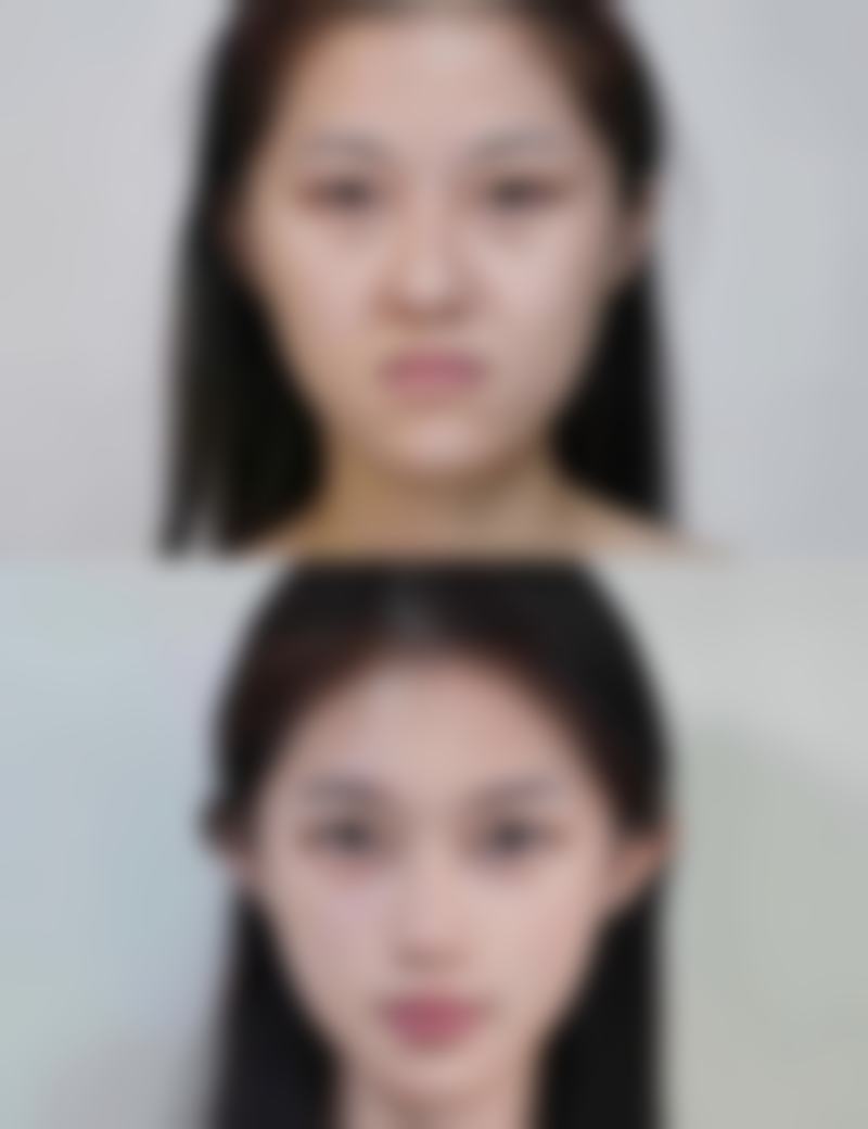割双眼皮后沾水需要注意什么