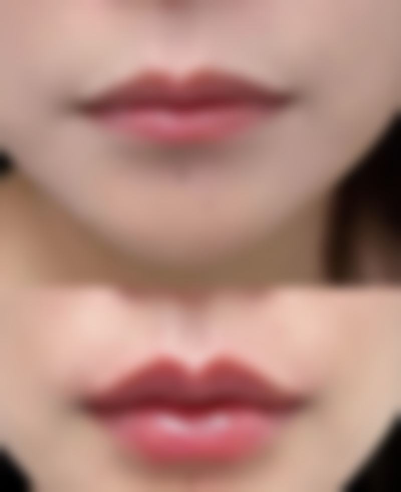 医美界去除眼袋淤青的3大方法靠谱吗