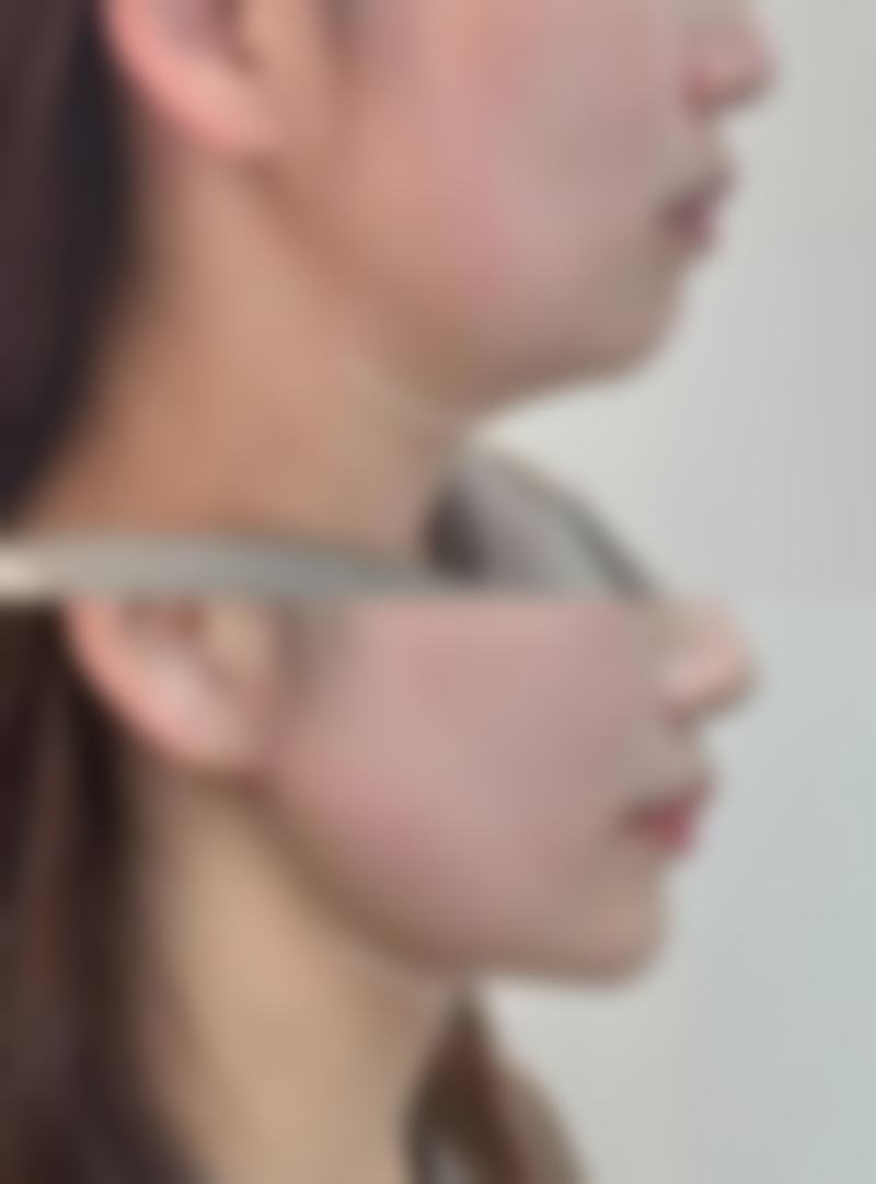 打除皱针后能按摩吗