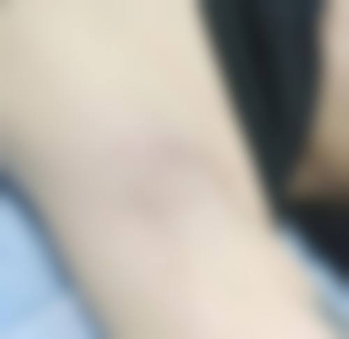 无为凯亨整形医院真实实例