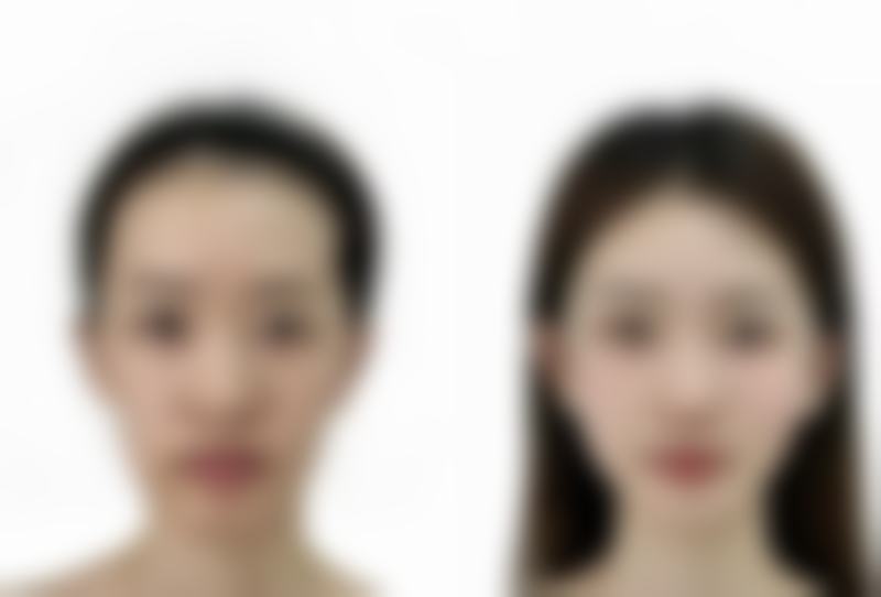 做双眼皮手术增生了激光治疗值不值