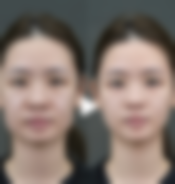 膨体隆鼻成效能维持20年以上是真的吗