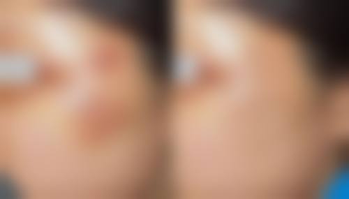 术后护理对双眼皮成效有什么影响