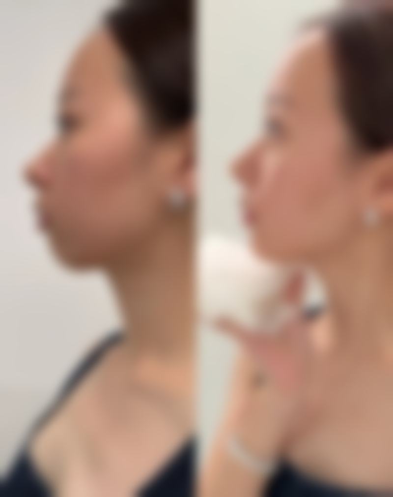 疤痕疙瘩抹药多久能看到成效