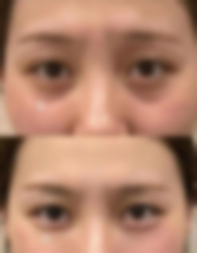 手术方式对隆鼻手术修复时间有什么影响