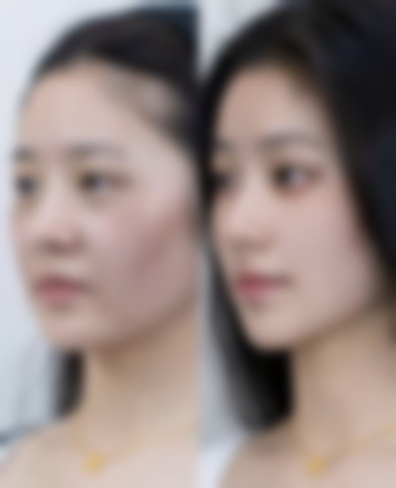 假体隆胸成效持久度高吗