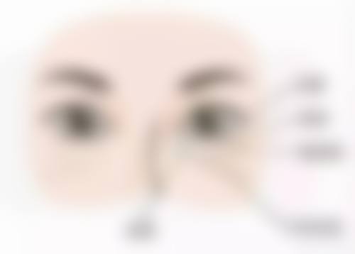 割完双眼皮一边肿一边不肿多久能修复正常呢