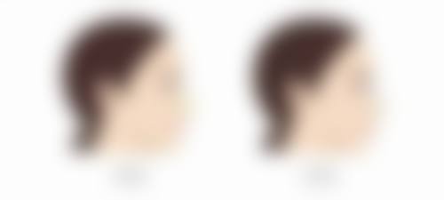 如何判断做完双眼皮后是否可以同房