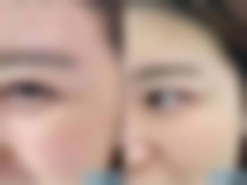 四个半月修复全切双眼皮适合吗