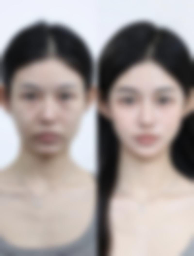 正规隆胸的危害可控吗?