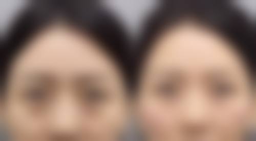 割双眼皮后需要定期复查吗