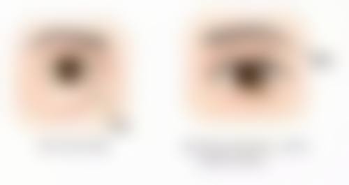 双眼皮埋线线能保持 3 - 5 年成效靠谱吗？