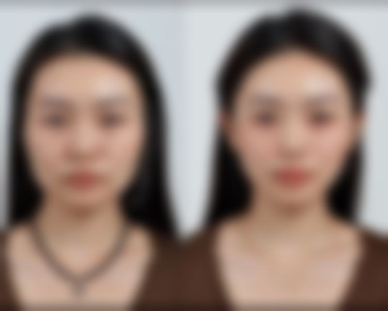 埋线双眼皮修复快是真的吗