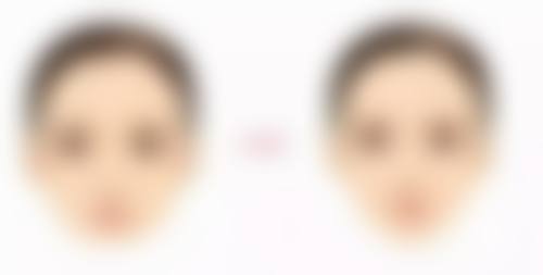 超声 刀去眼袋和手术去眼袋哪个更好