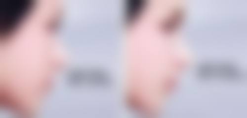 打完瘦脸针化浓妆会怎么样