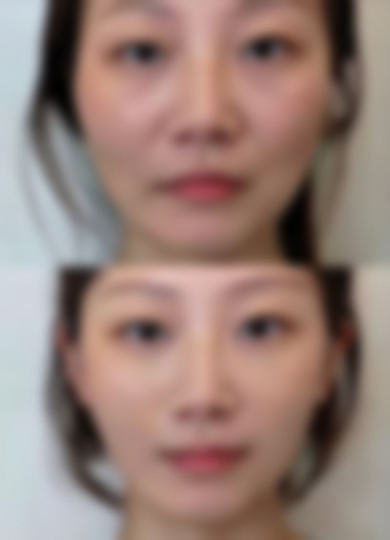 打完瘦脸针化妆需要注意什么