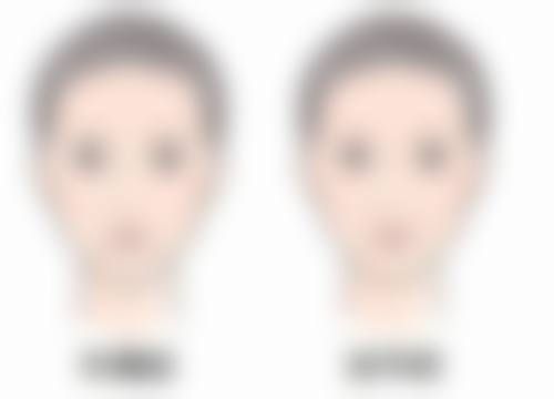心脏不好做眼袋手术值不值