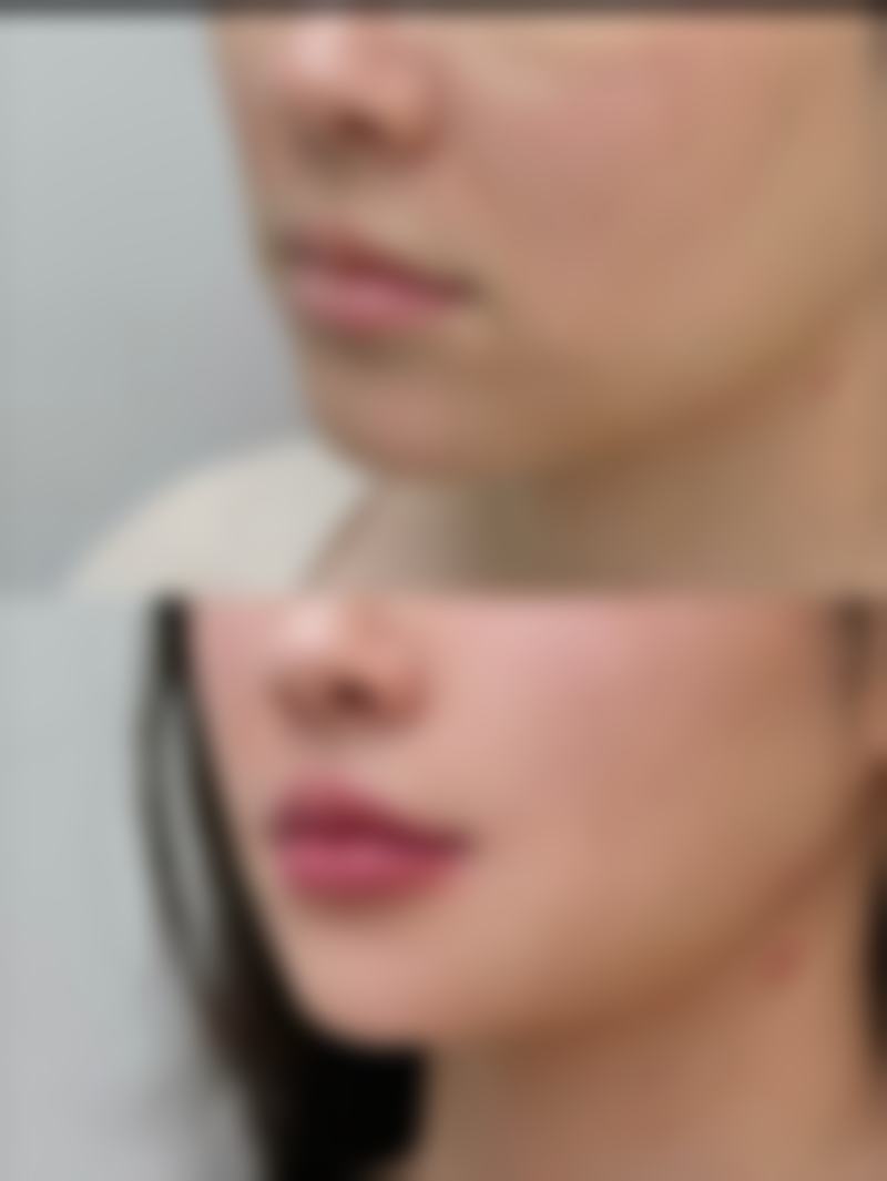 一年多的凹陷疤痕用多磺酸粘多糖乳膏修复靠谱吗