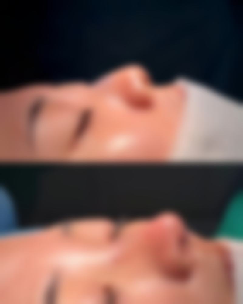 常见误区与避坑指南:如何避免双眼皮手术失败与修复不良