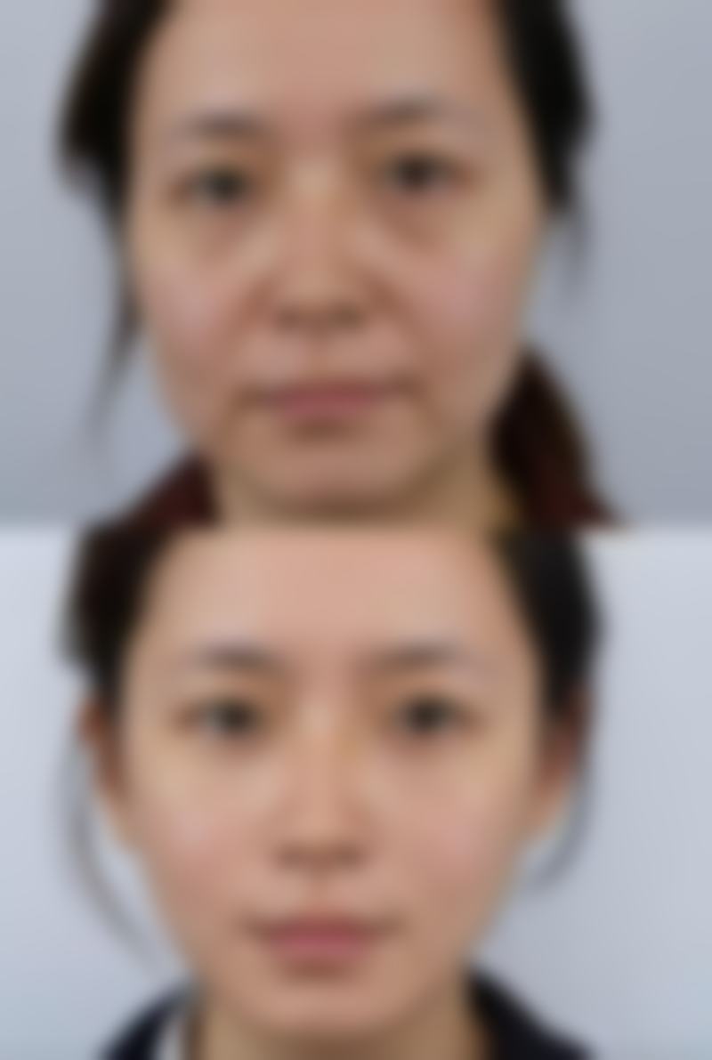 国内一二线城市热门机构瘦脸针80单位实测与价格解析
