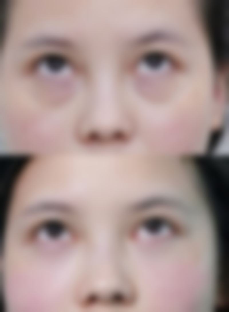 术后脸型更精致的关键因素