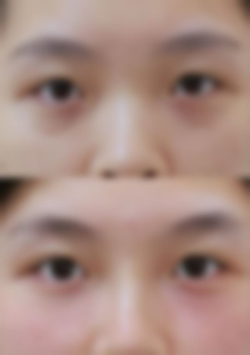 2026黑眼圈眼袋怎么去除?激光医美+生活调理双管齐下,告别熊猫眼,重现明亮双眸超实用!