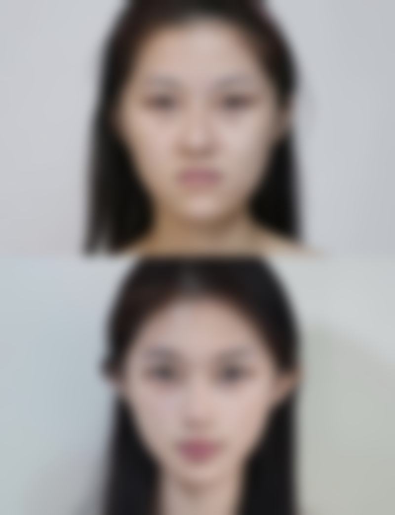隆胸乳晕切口疤痕明显吗?术后护理与疤痕管理的黄金法则