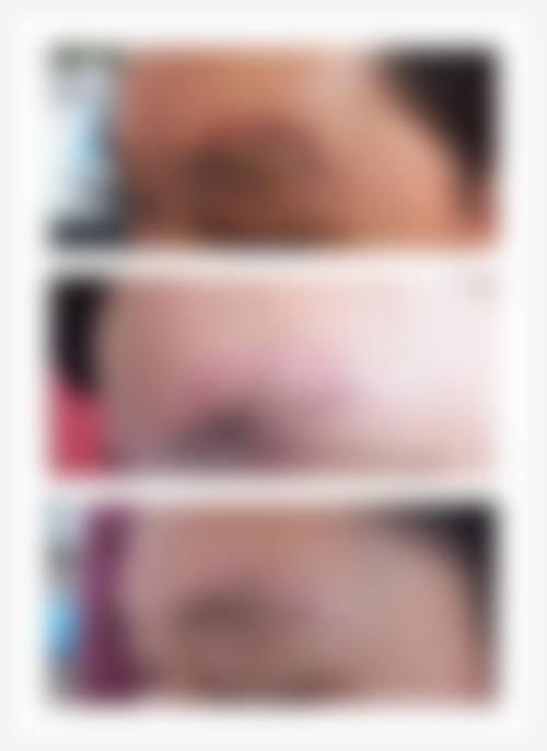 陈月丽在眼部整形领域的极致匠心与差异化技术亮点