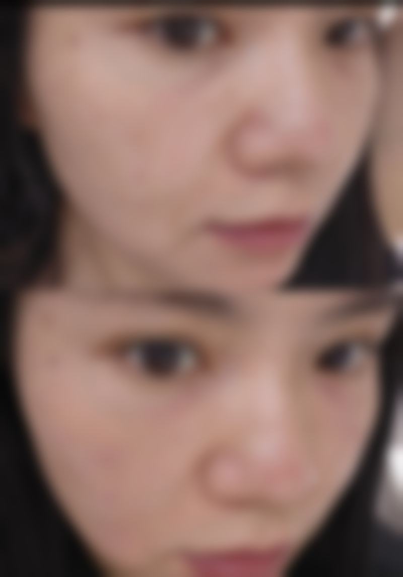 假体隆胸多久能完全修复?2026年详解消肿周期,助你安心变得更美无负担