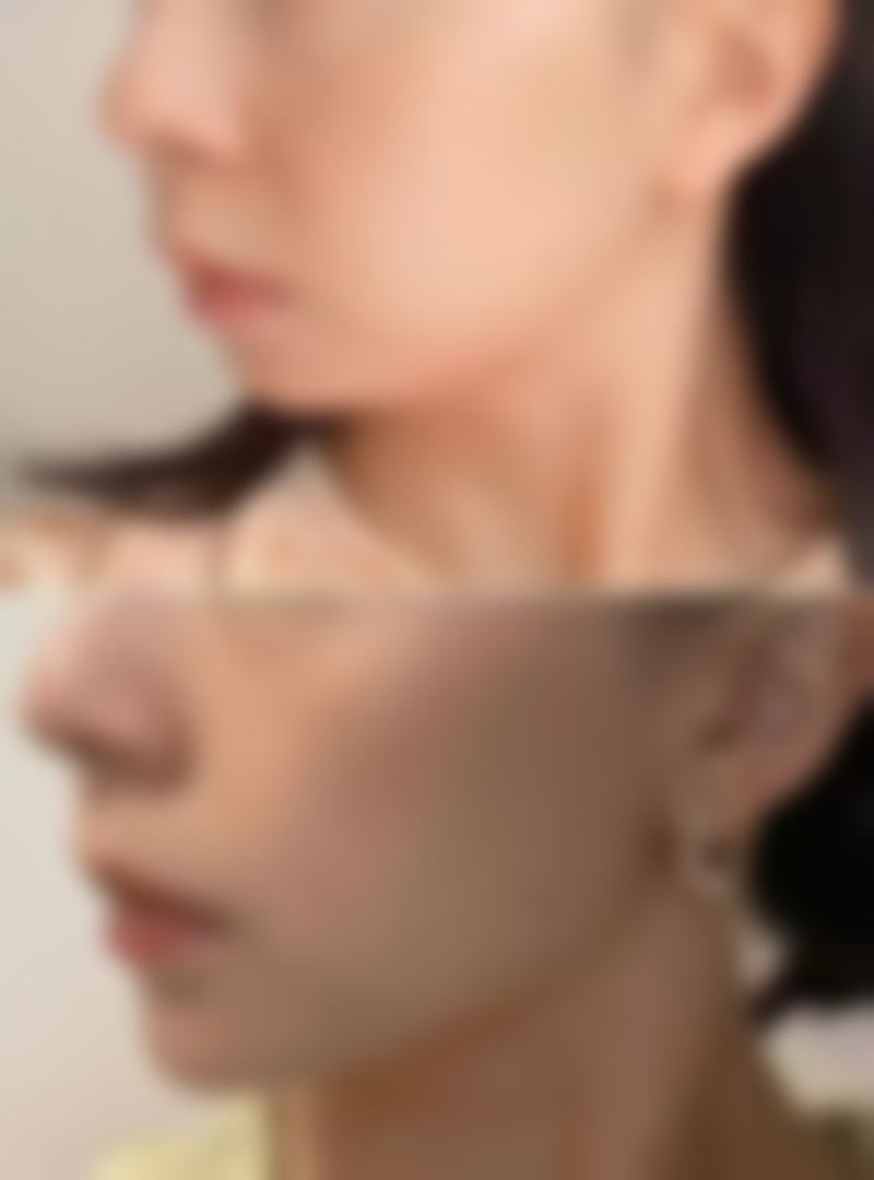闫峰医生的技术核心：小创口拉皮与MACS提升术的深度解析