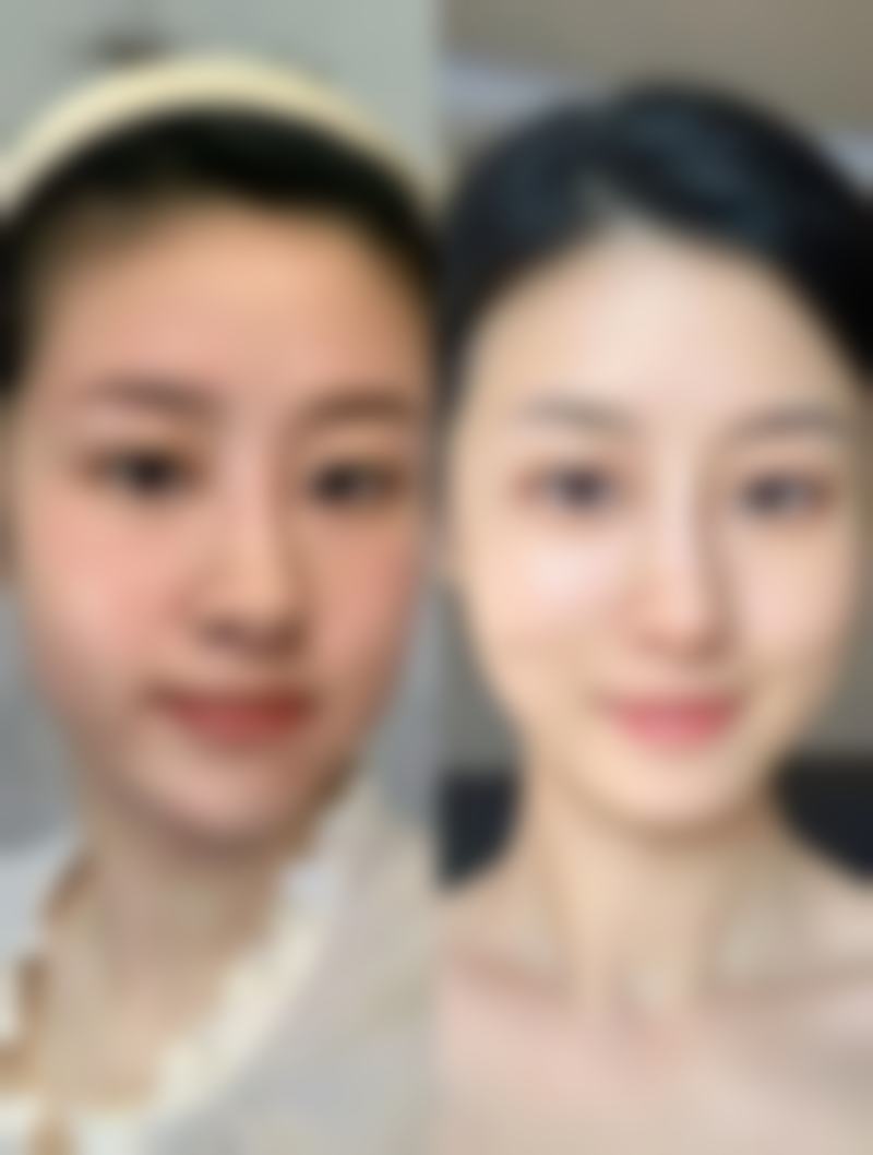 香港CosMax医学美容中 心黄金双波射频8100HKD