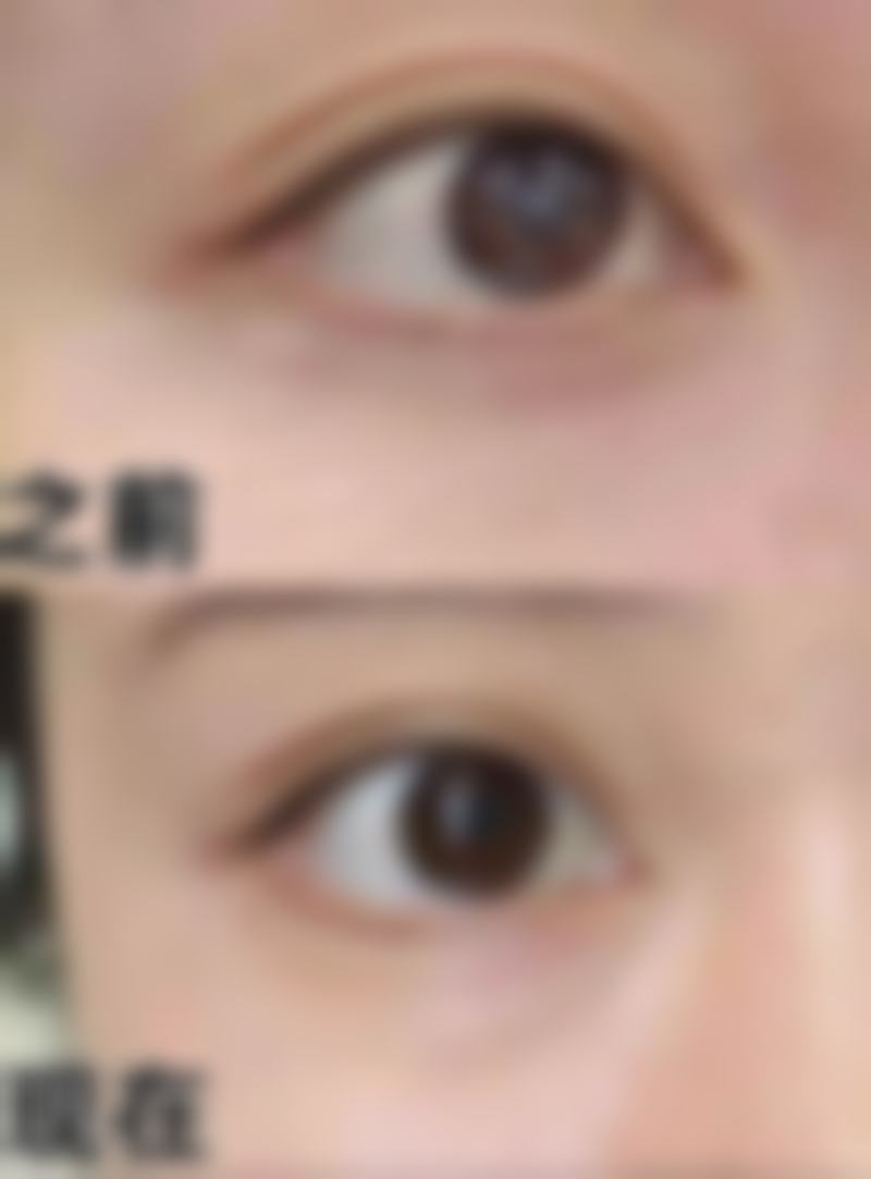 注射隆胸有后遗症吗?揭秘捷克水分子致硬块的恐怖真相