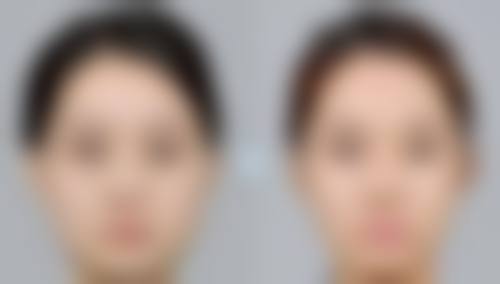 术后护理与注意事项:确保激光祛疤成效的较大化