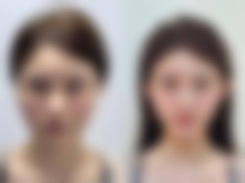 韩国星愿整形外科术后护理与修复周期科学管理